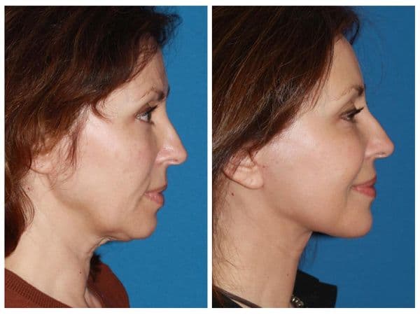 Before & After Advanced Facelift
