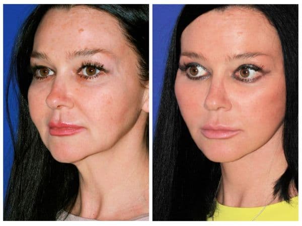 Before & After Advanced Facelift & Blepharoplasty