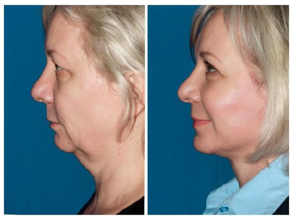Before & After Advanced Facelift & Blepharoplasty