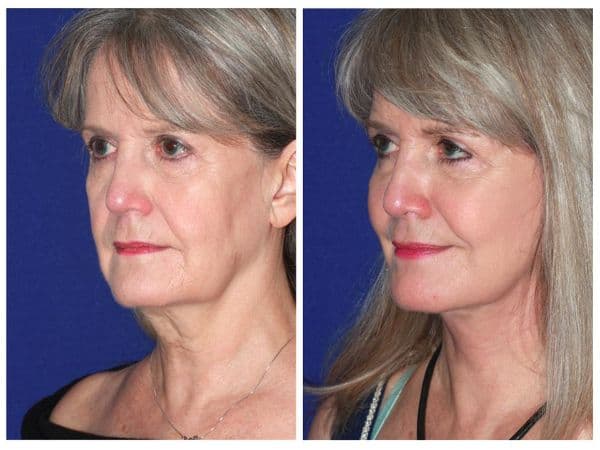Before & After Advanced Facelift