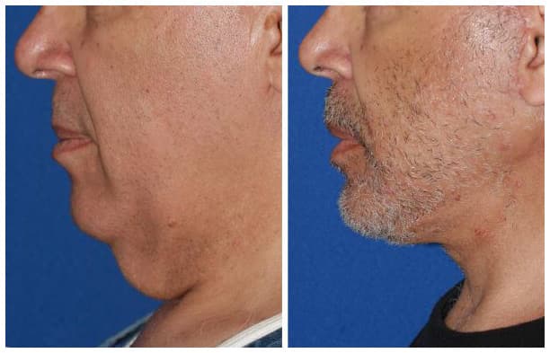 Before & After Male Face & Neck Lift
