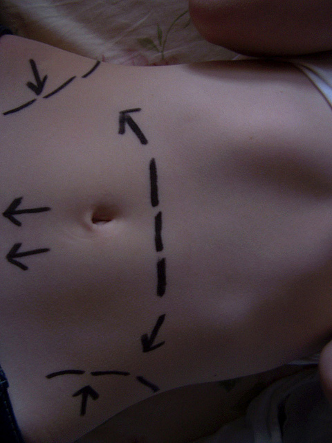 plastic surgery markings