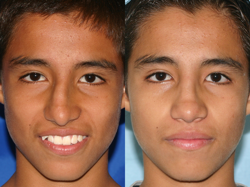 good nose job before and after