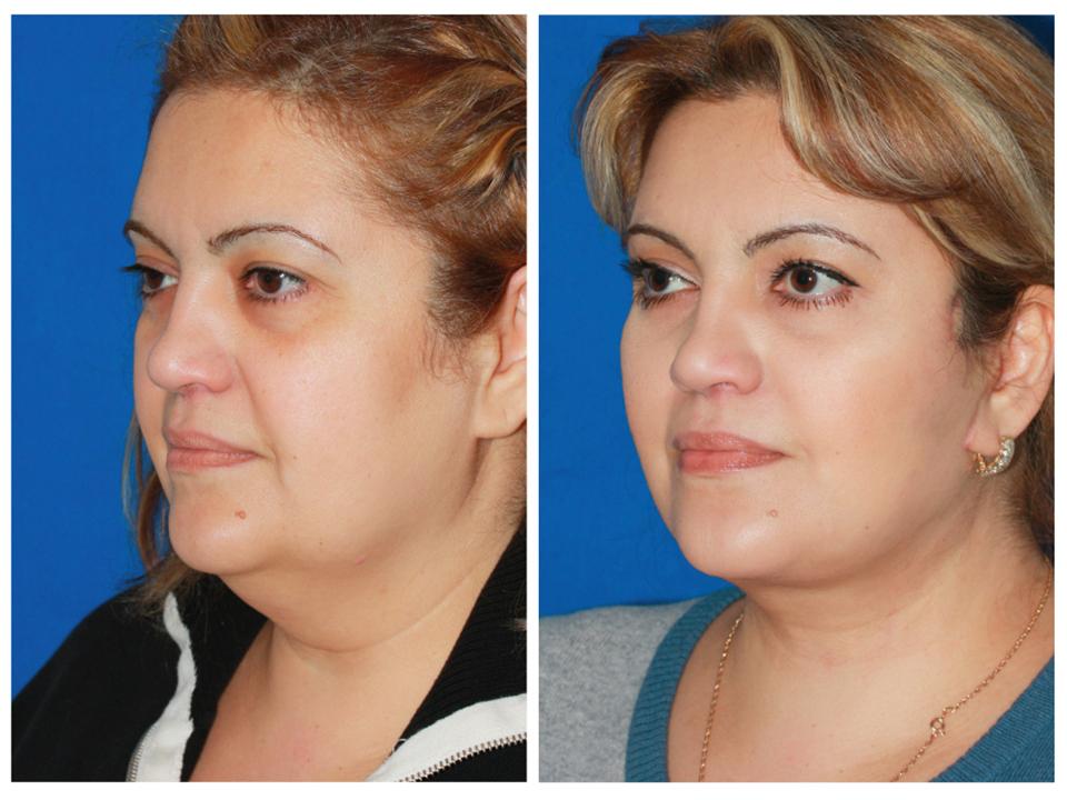 Before and after images of a woman's facelift results.