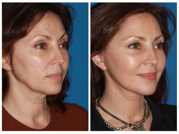 Before and after of facelift