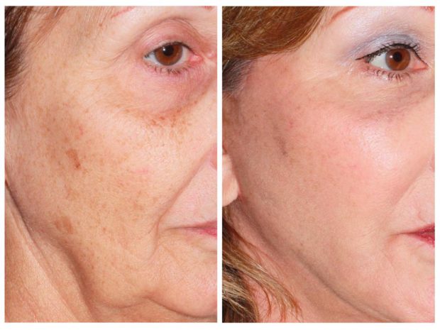 Before and after of laser skincare