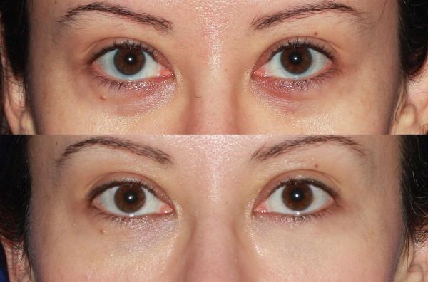 before and after of blepharoplasty