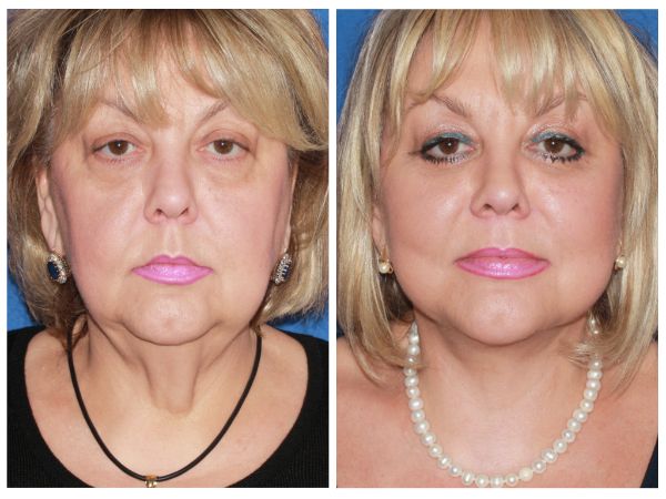 Advanced Facelift case #46 before photo