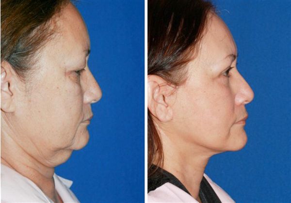 before and after of blepharoplasty