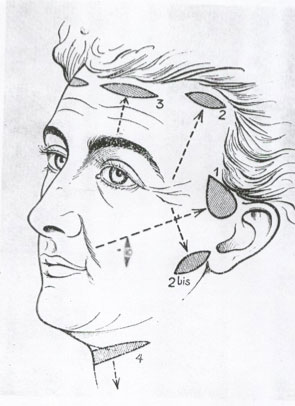 Drawing of different facelift incision locations