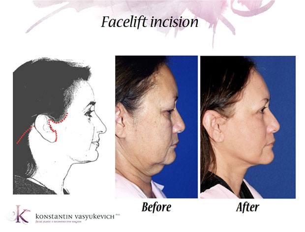 A drawing and photos of the modern, less visible facelift incision