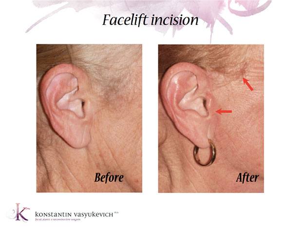 A photo of a modern, less visible facelift scar around the ear and hairline