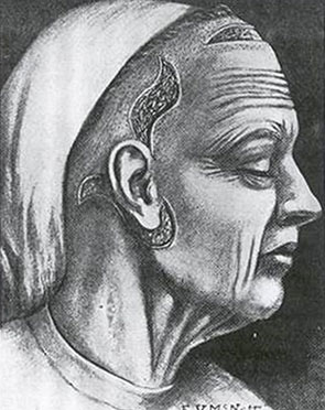 Drawing of a head with long facelift incisions
