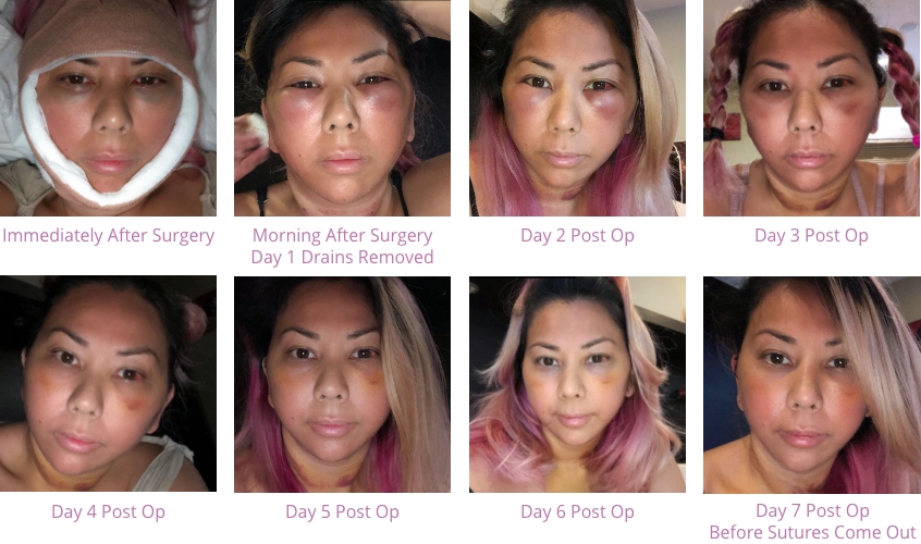 eii-show-for-large A series of photos of facelift recovery progress