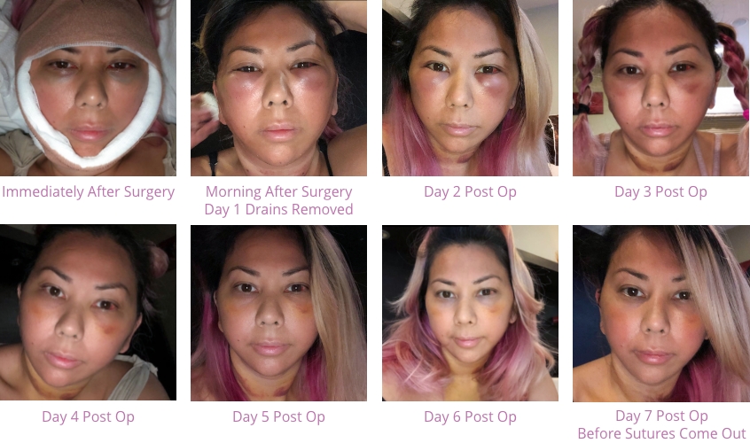 A series of photos of facelift recovery progress