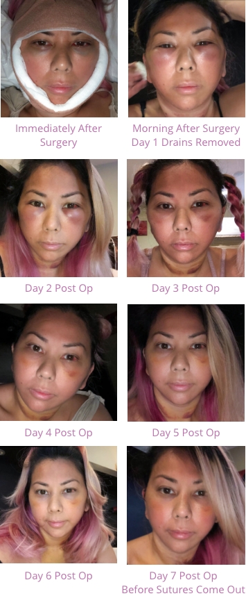 A series of photos of facelift recovery progress