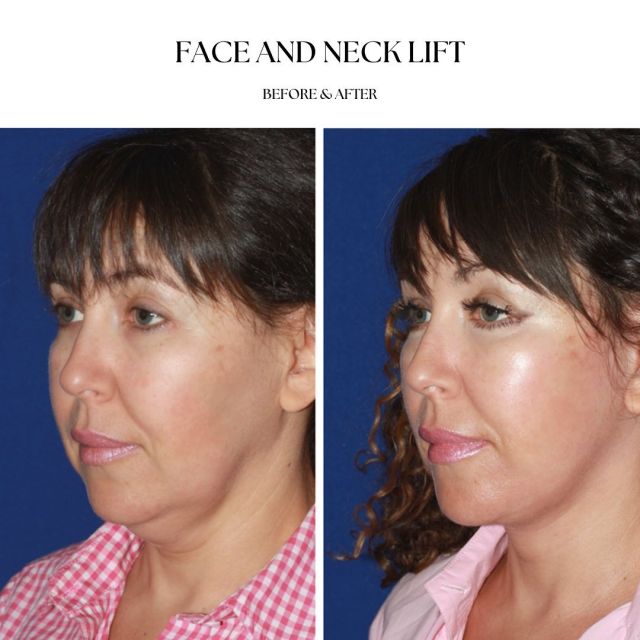 Face and neck lift for my lovely and beautiful patient to smooth out the contour of the face, elevate the cheeks and remove excess skin under the chin.