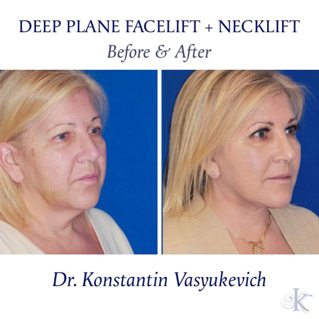 Great example of a full rejuvenation with a deep plane facelift combined with a necklift. This is a natural looking result that will last as you go back to your younger self from 10 to 15 years ago. #beforeandafter #deepplanefacelift #neckliftnyc #plasticsurgery #deepplanefaceliftbeforeandafter #plasticsurgerybeforeandafter #faceliftbeforeandafter