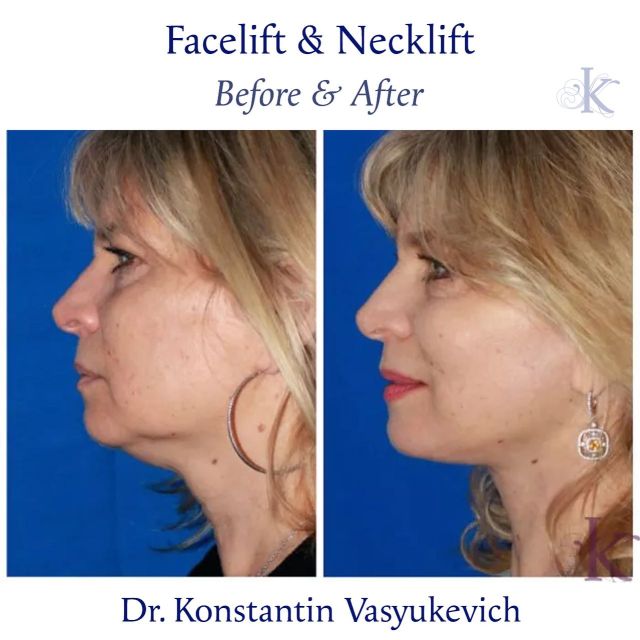 Natural results that you can see! Facelift plus necklift for a rejuvenated face that looks like you. Book your in-person or online consultation now. Link is in bio #beforeandafter #beforeafter #beforeafterfacelift #beforeandafterfacelift #beforeafternecklift #beforeandafternecklift
