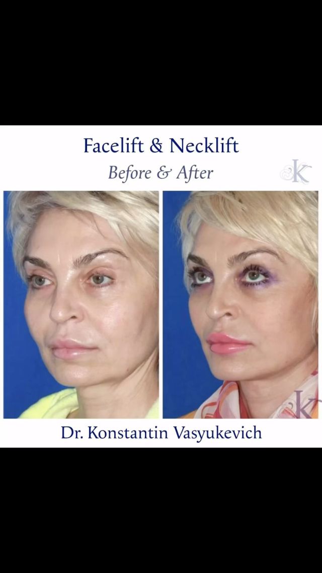 Before and after snapshots: our latest facelift and necklift transformations speak volumes. Precision meets beauty in every procedure. #Facelift #Necklift #plasticsurgery
