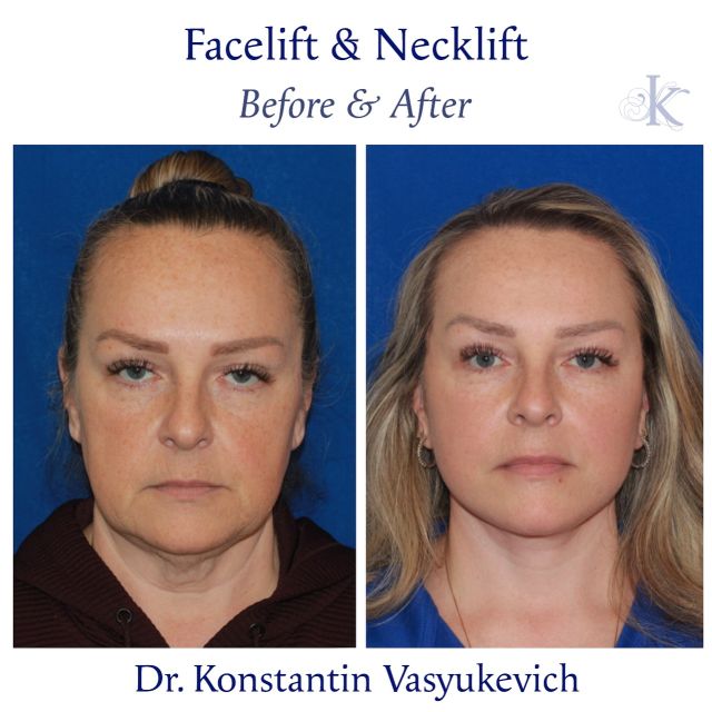 Transforming lives, one lift at a time! ✨Stunning transformation with a face and neck lift for a youthful and natural look. #facelift #beautyunveiled #necklift