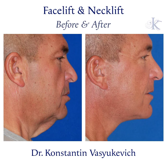 Refined jawline, restored confidence. Age gracefully on your own terms. #malefacelift #neckrejuvenation