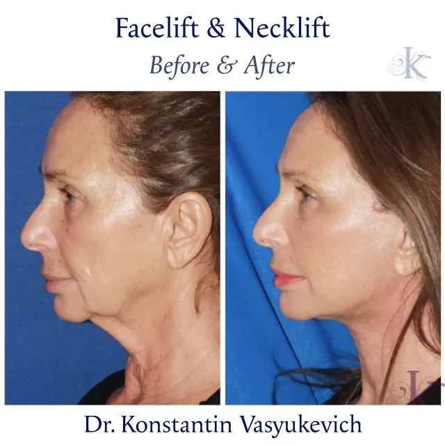 Noticeable yet natural rejuvenation showcasing expert technique in combined facelift and necklift. Years reversed with precision and care. #facelift #necklift #transformation #nycsurgeon