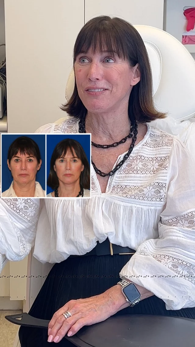 Facelift experience: When your glow-up is so good, people stop offering you their seat on the subway! Sometimes the best compliment isn’t what people say, it’s what they do. 

#facelift #faceliftnyc #plasticsurgeryresults #beforeandafter #plasticsurgery #nycplasticsurgeon #glowup #patienttestimonial