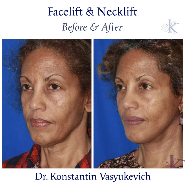 Fresh look, smooth neck, renewed confidence. Book your online or in-person now. Link in bio. 
#facelift #necklift #transformation #facialrejuvenation