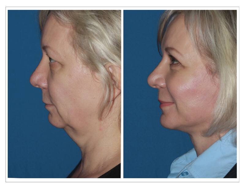 Dr. Konstantin Finding the Best Deal on your Facelift Should Not Be That Hard