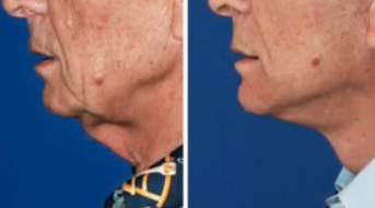 Dr. Konstantin Vasyukevich The Male Neck Lift