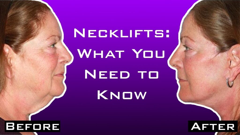 Dr. Konstantin Can I Get A Neck Lift Without A Facelift?