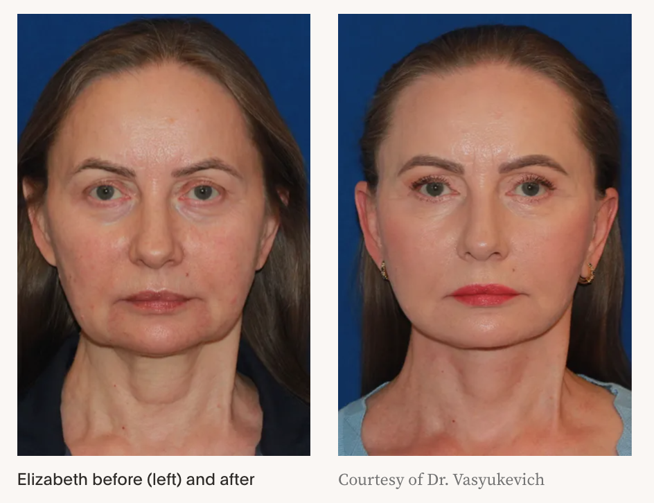 Before and after results