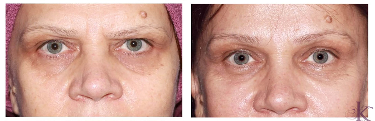 Before & After Browlift Case 71 View #1 View in NYC New York, NY