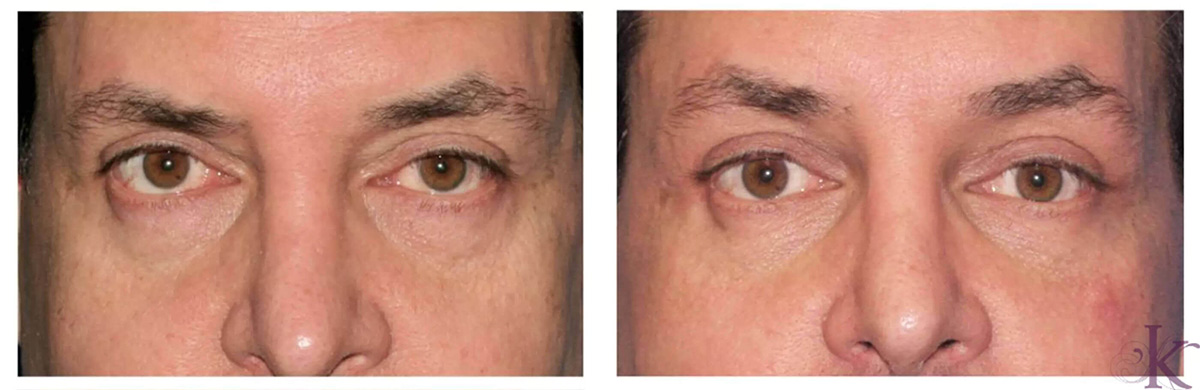 Before & After Browlift Case 72 View #1 View in NYC New York, NY
