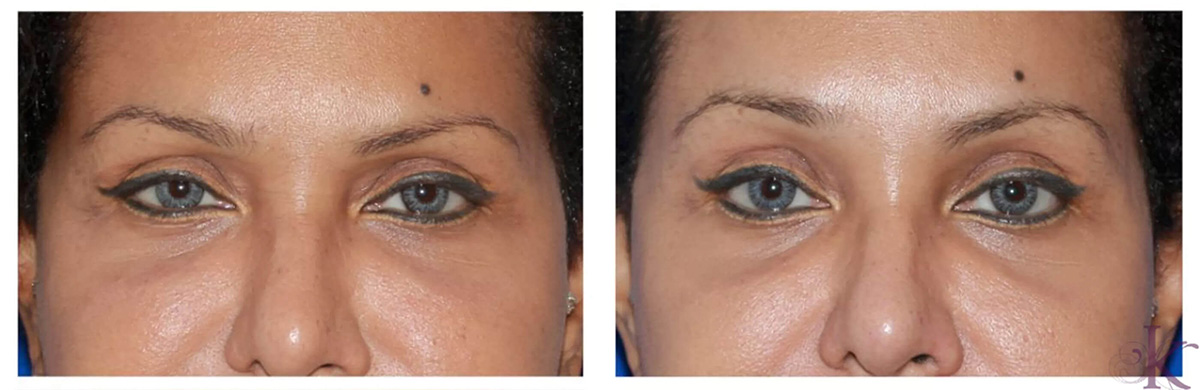 Before & After Browlift Case 73 View #1 View in NYC New York, NY