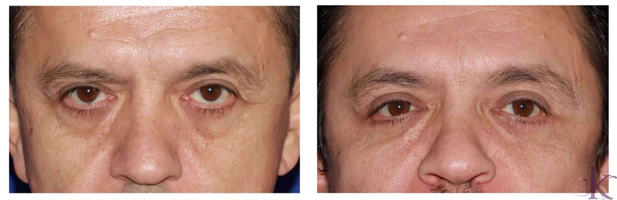 Before & After Browlift Case 75 View #1 View in NYC New York, NY