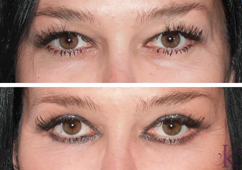 Before & After Blepharoplasty Case 117 Front View in NYC New York, NY