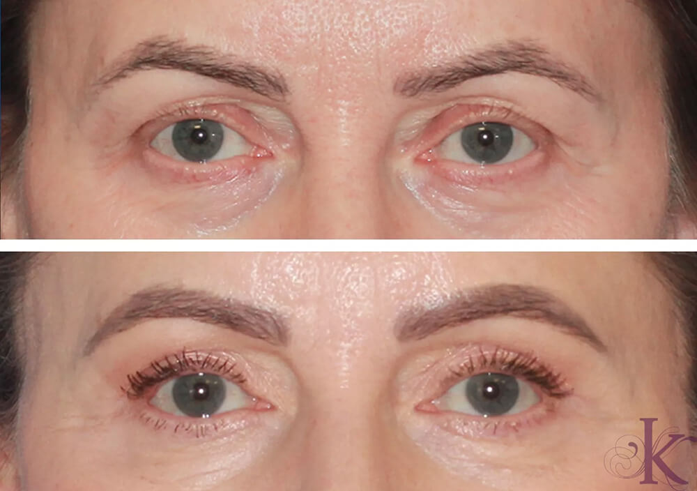 Before & After Blepharoplasty Case 120 Front View in NYC New York, NY