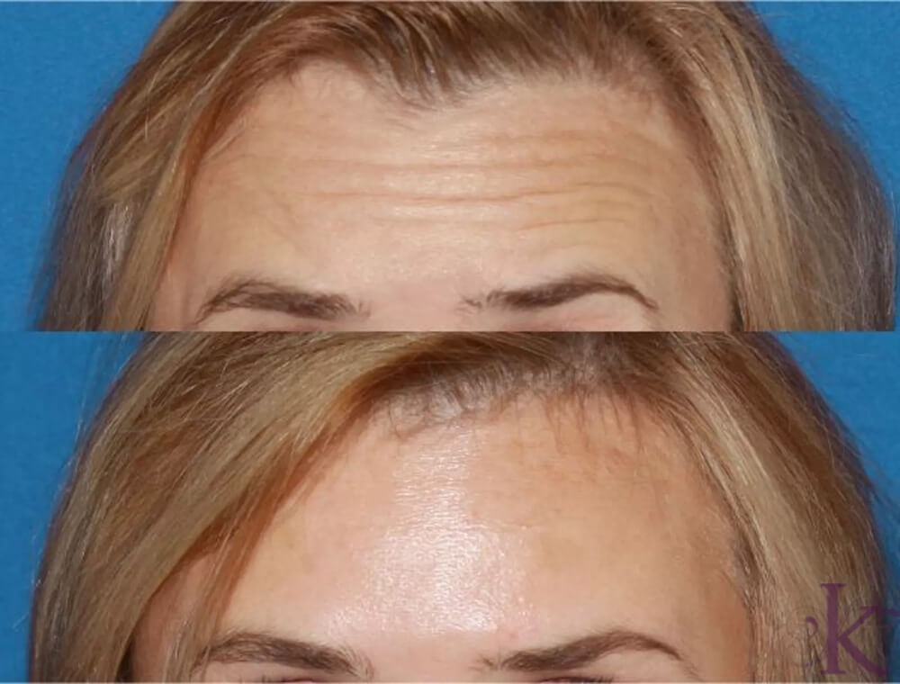 Before & After BOTOX, Dysport & Xeomin Case 37 View #1 View in NYC New York, NY