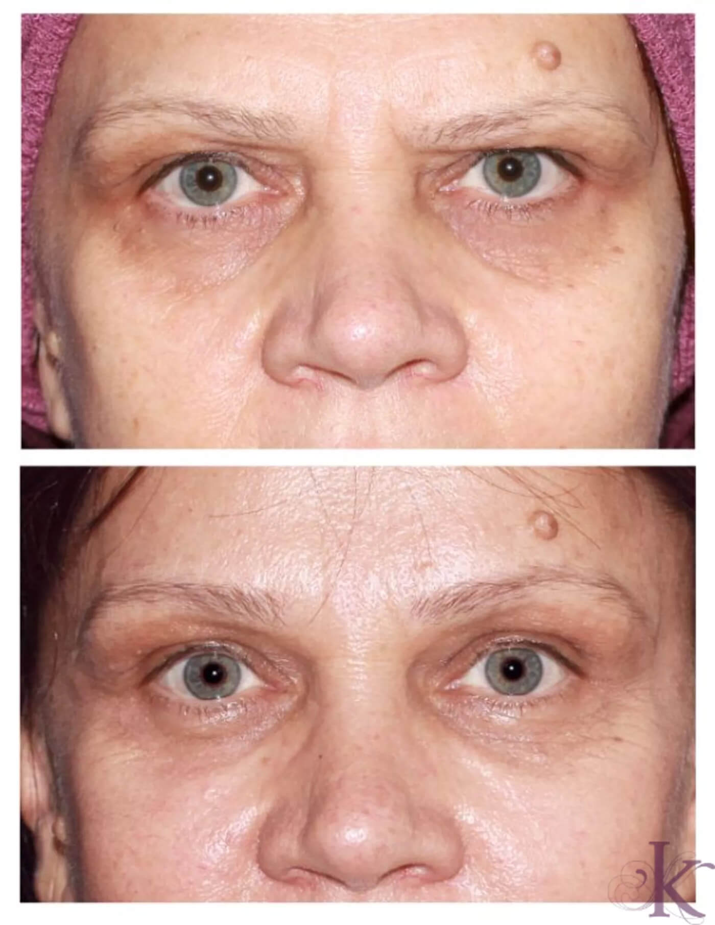 Before & After Browlift Case 71 View #1 View in NYC New York, NY