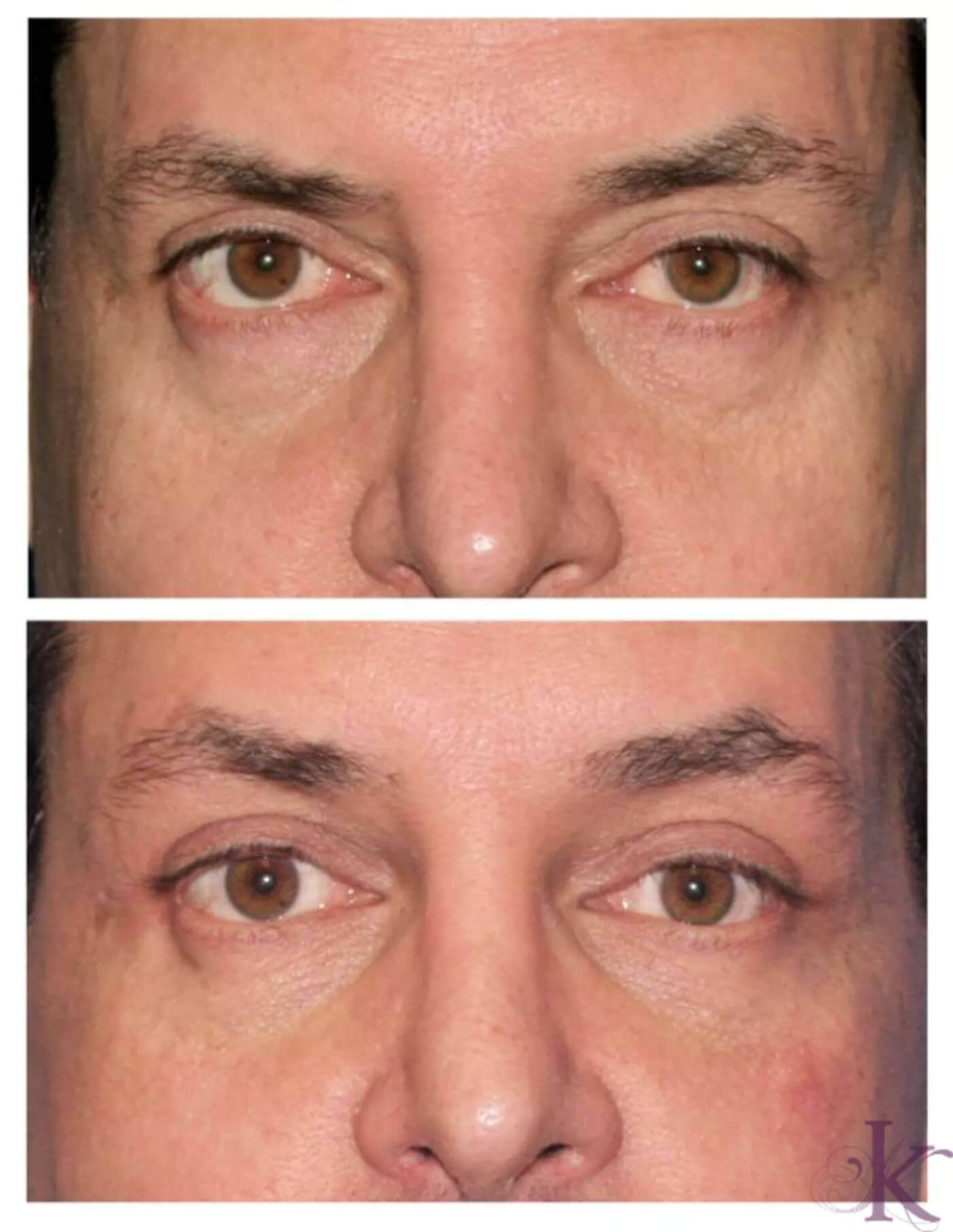 Before & After Browlift Case 72 View #1 View in NYC New York, NY