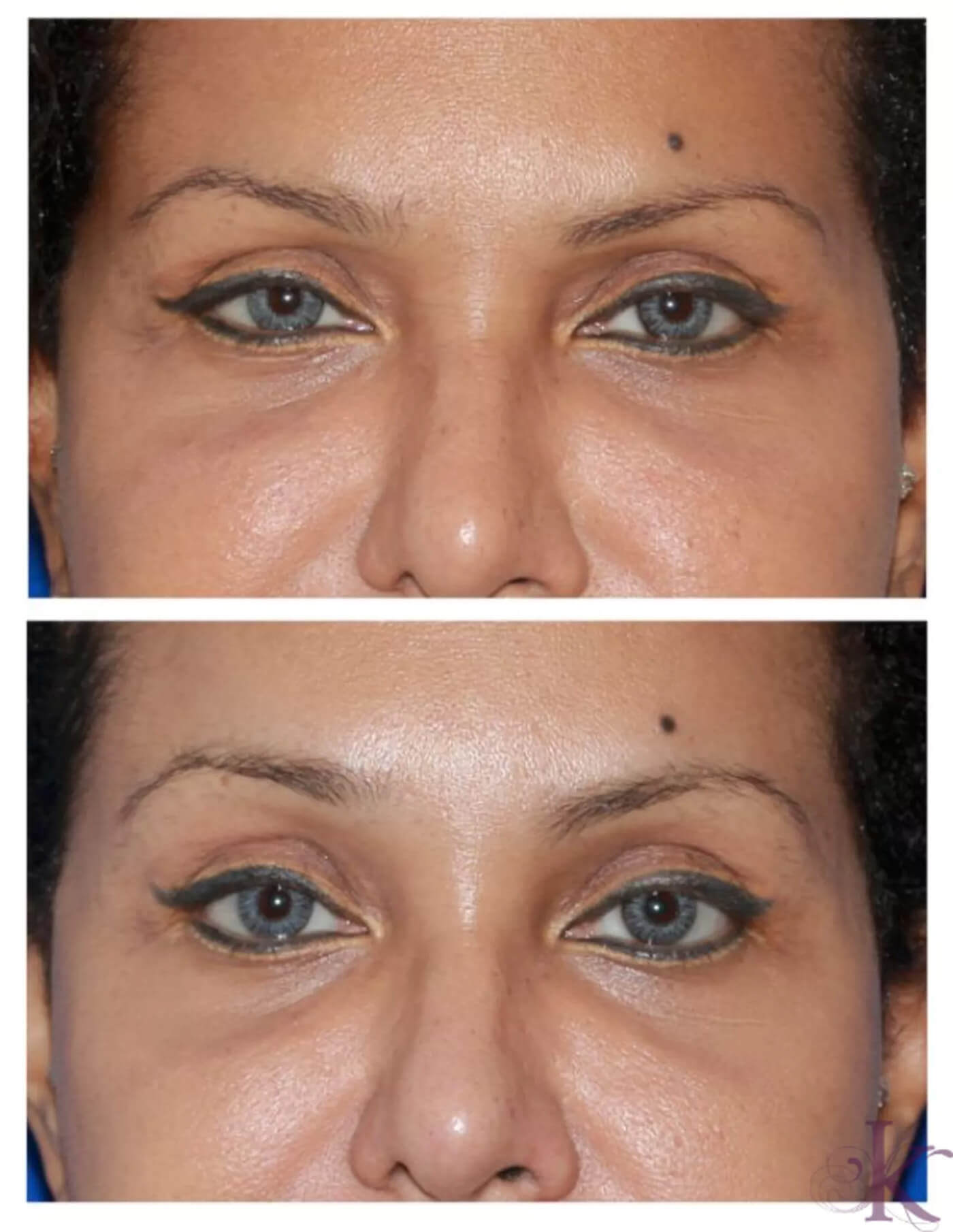 Before & After Browlift Case 73 View #1 View in NYC New York, NY
