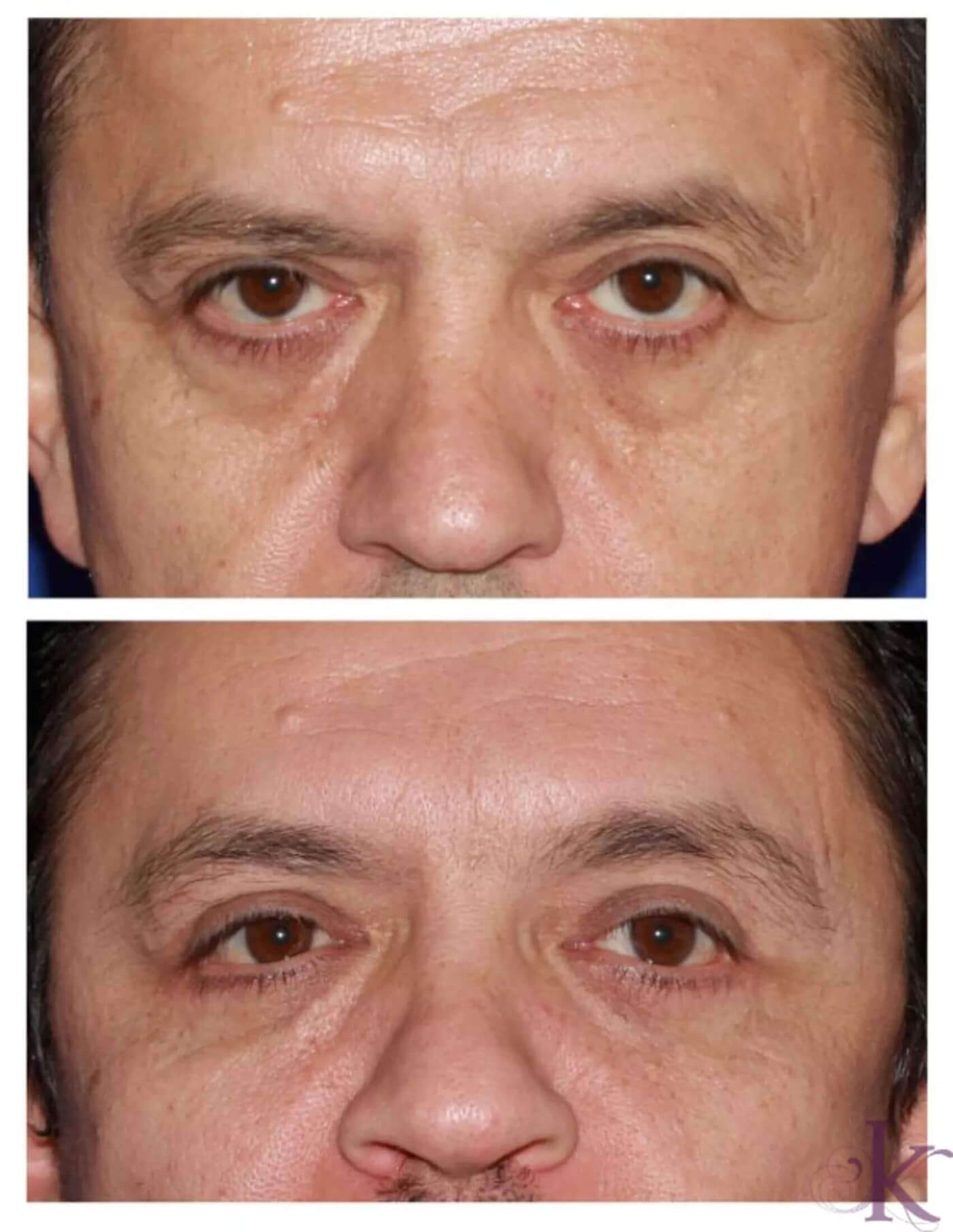 Before & After Browlift Case 75 View #1 View in NYC New York, NY