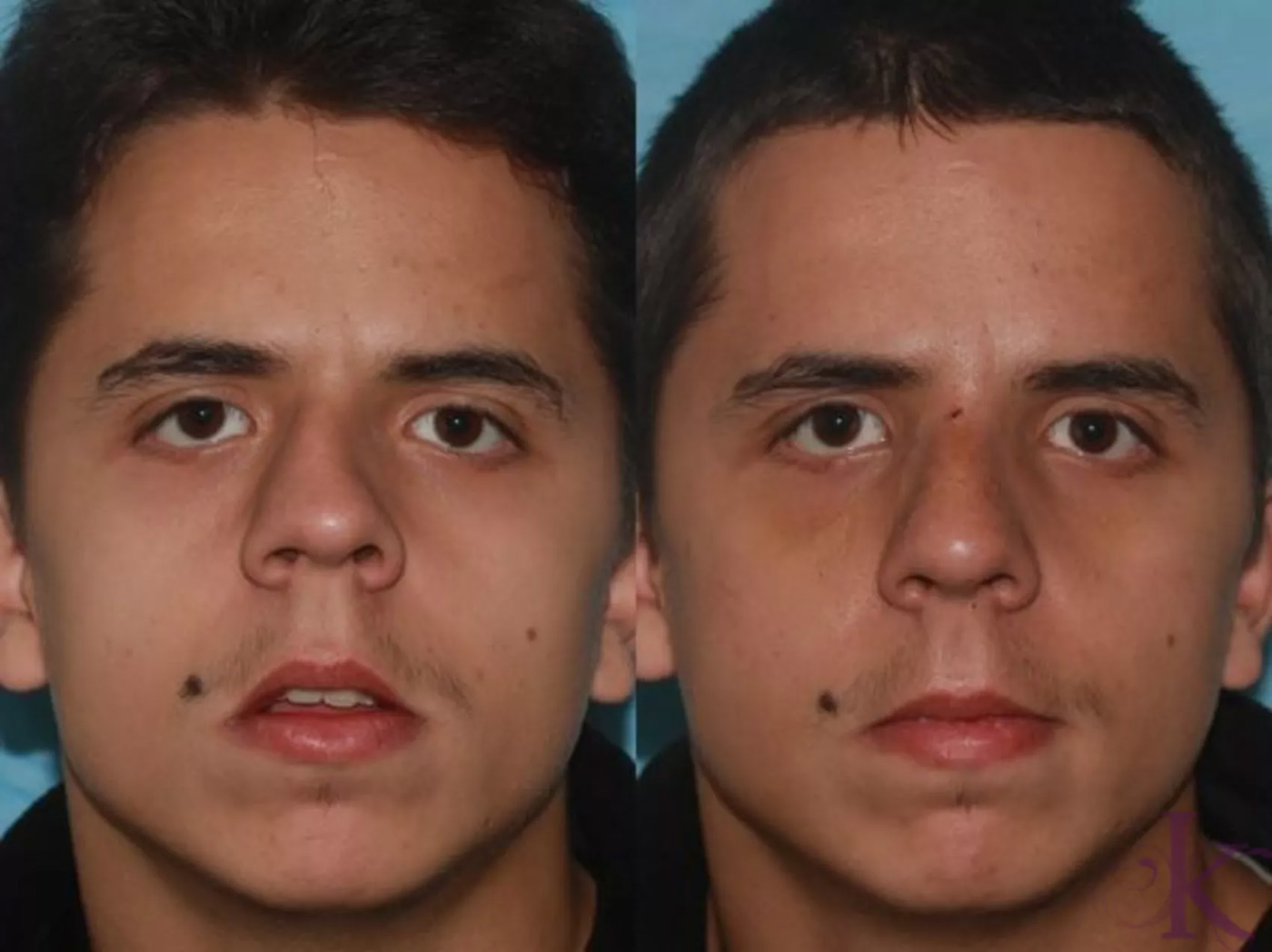 Before & After Cosmetic Rhinoplasty Case 15 View #1 View in NYC New York, NY