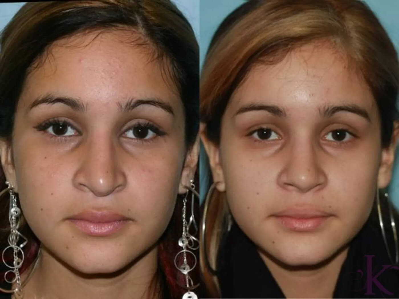 Before & After Cosmetic Rhinoplasty Case 16 View #1 View in NYC New York, NY