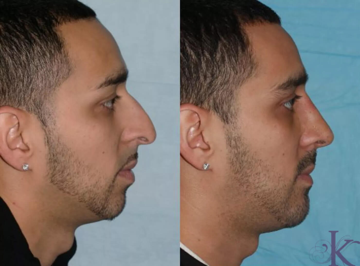 Before & After Cosmetic Rhinoplasty Case 17 View #1 View in NYC New York, NY