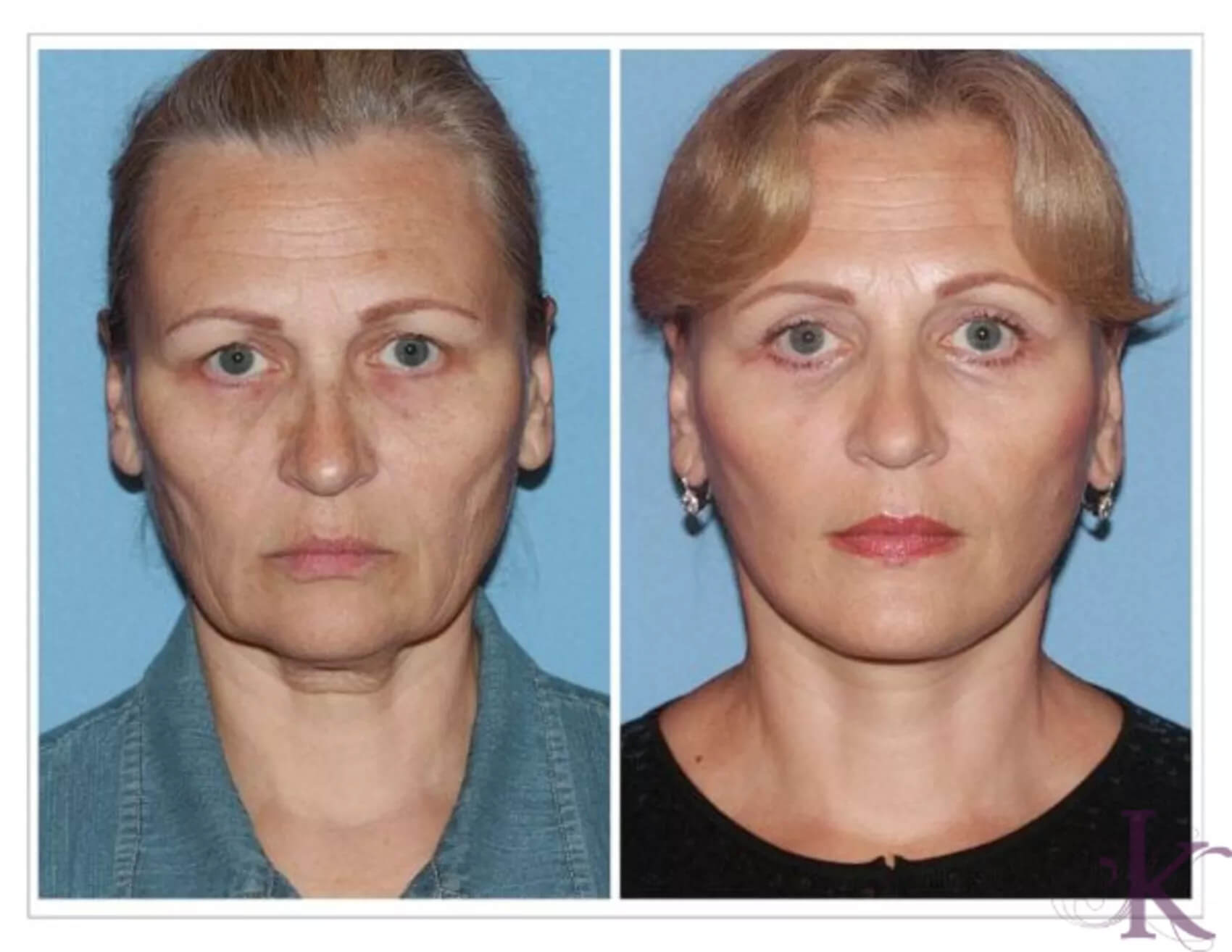 Before & After Facelift Case 10 View #1 View in NYC New York, NY