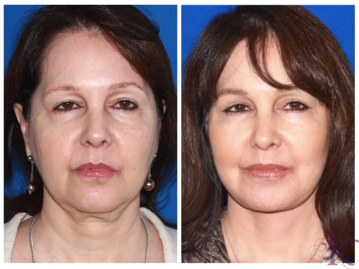 Before & After Facelift Case 100 View #1 View in NYC New York, NY