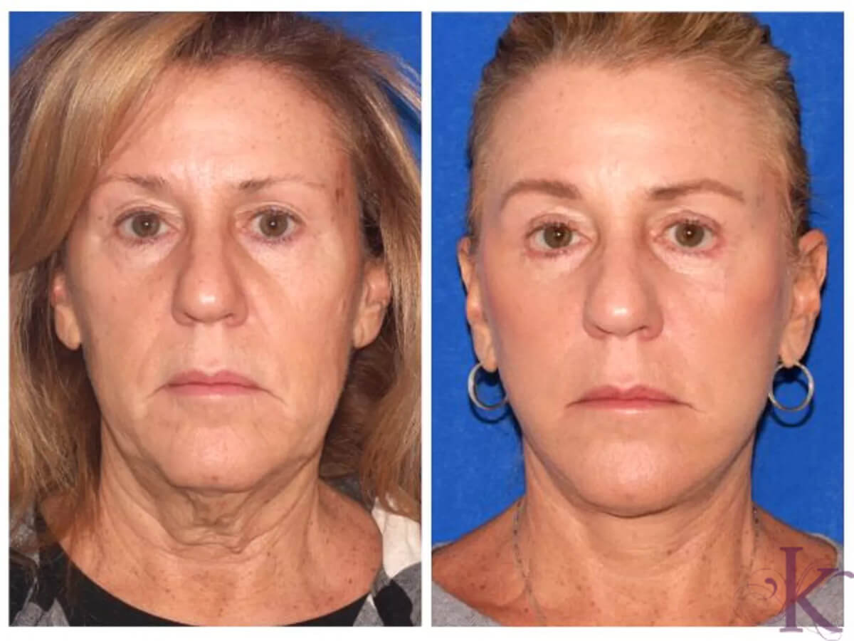 Before & After Facelift Case 104 View #1 View in NYC New York, NY